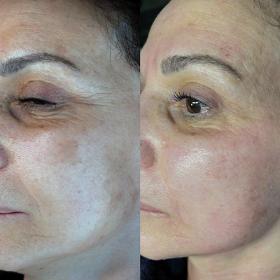 Antes - Rostro