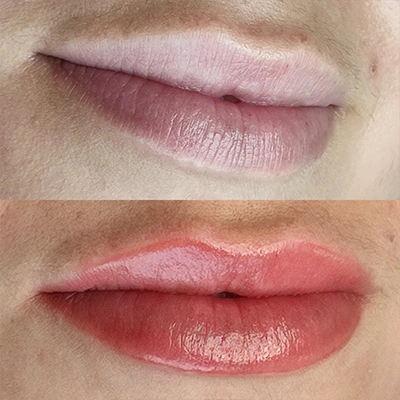 Antes - Labios