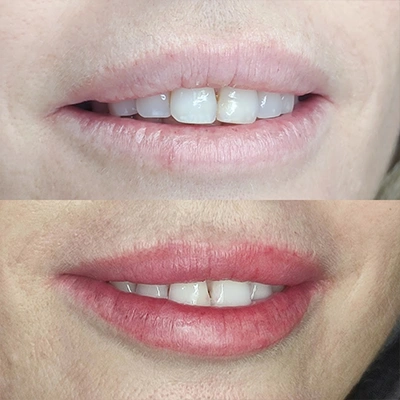 Después - Labios