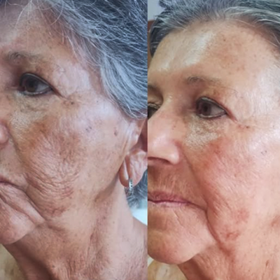 Después - Rejuvenecimiento Facial